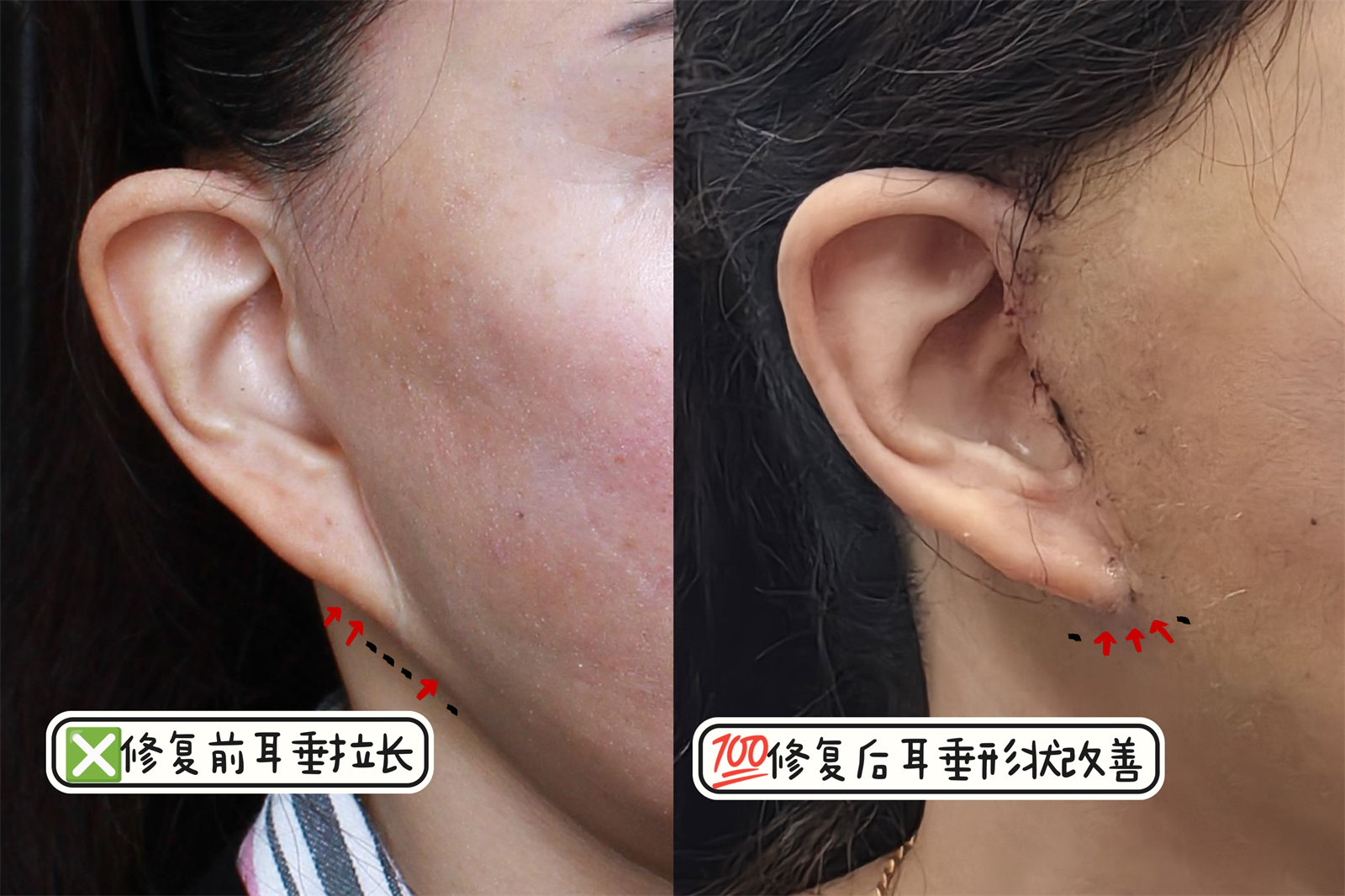 48岁做二次拉皮,亲身经历告诉你如何不走“弯路”! 48岁做二次拉皮,亲身经历告诉你如何不走“弯路”!