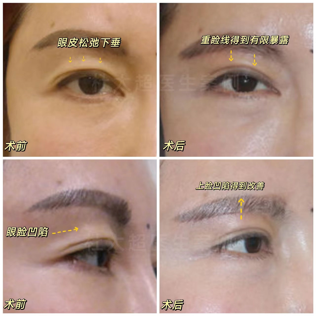 眼睛无神显老,一招改善眼皮松弛衰老问题! 眼睛无神显老,一招改善眼皮松弛衰老问题!