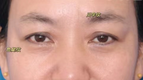 关于拉皮手术提升/除皱,来自求美者的提问与医生回复 关于拉皮手术提升/除皱,来自求美者的提问与医生回复