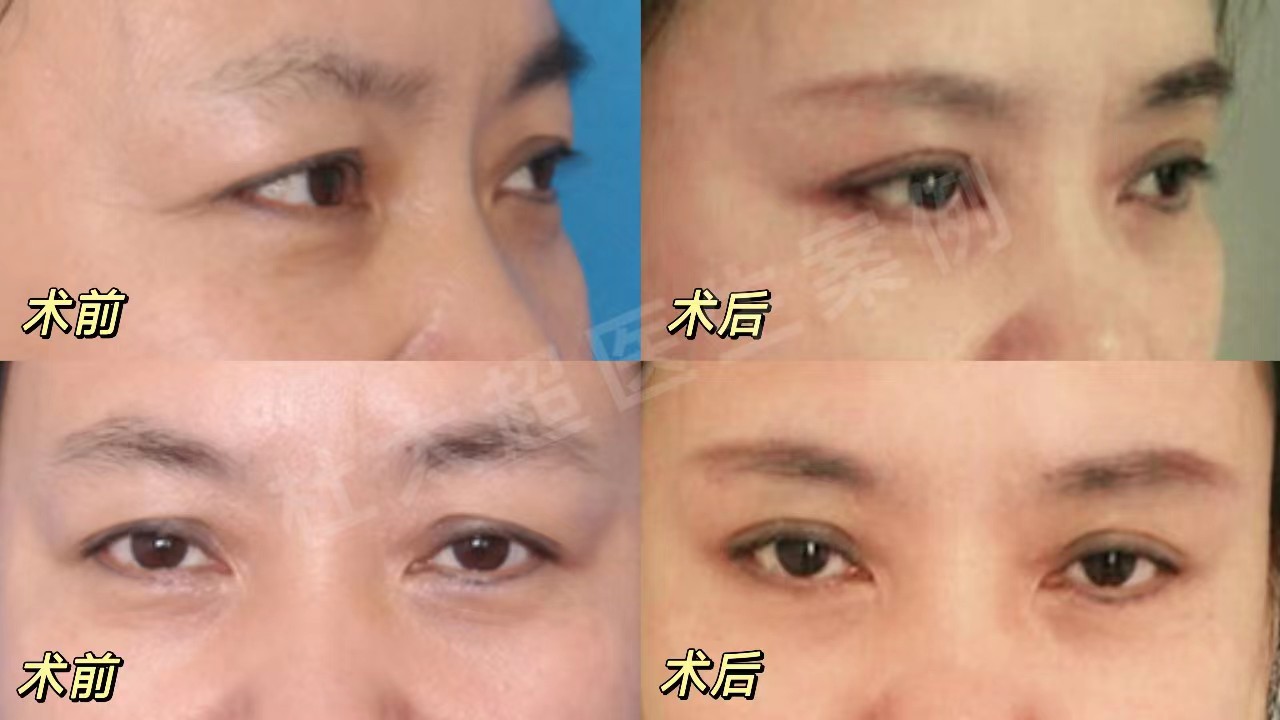 关于拉皮手术提升/除皱,来自求美者的提问与医生回复 关于拉皮手术提升/除皱,来自求美者的提问与医生回复