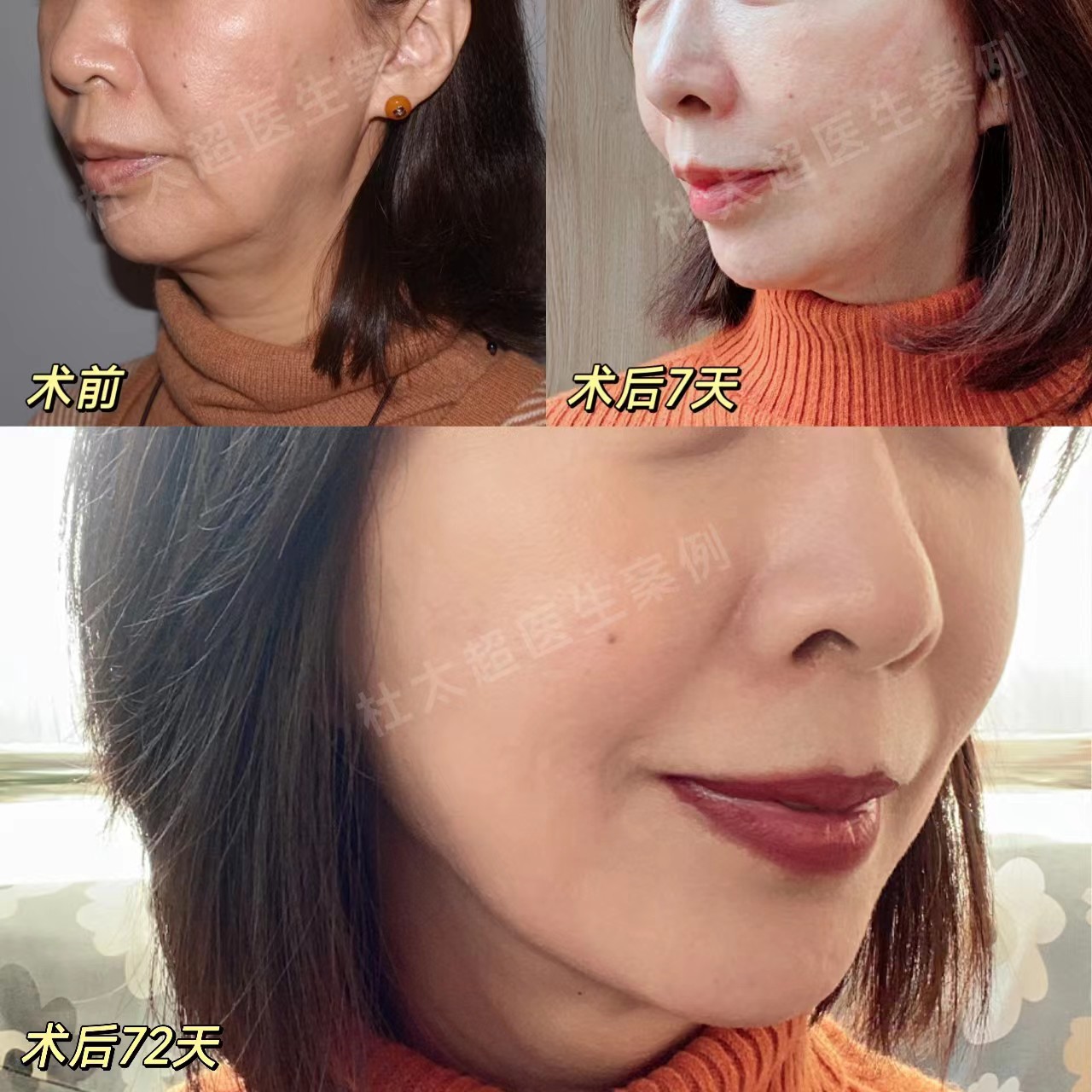 关于拉皮手术提升/除皱,来自求美者的提问与医生回复 关于拉皮手术提升/除皱,来自求美者的提问与医生回复