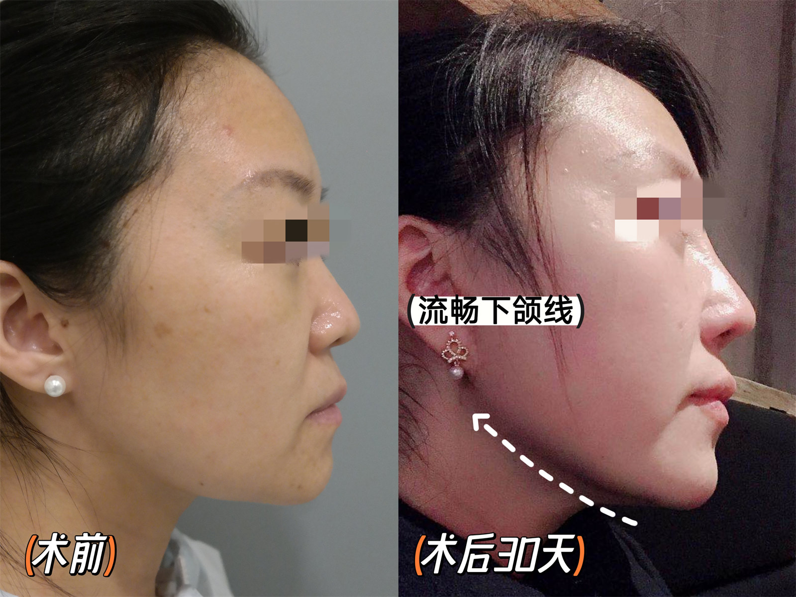 36岁做了拉皮手术,结合亲身感受,回复大家的3个问题 36岁做了拉皮手术,结合亲身感受,回复大家的3个问题