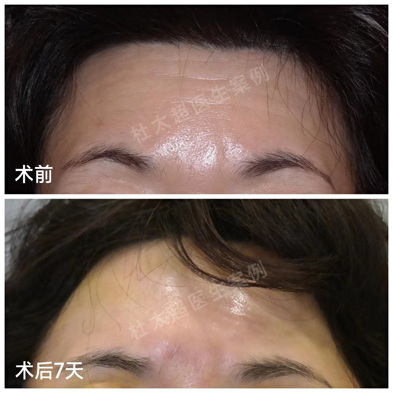 额纹“杀手”来了!额部每一道纹路都可以被抹平 额纹“杀手”来了!额部每一道纹路都可以被抹平