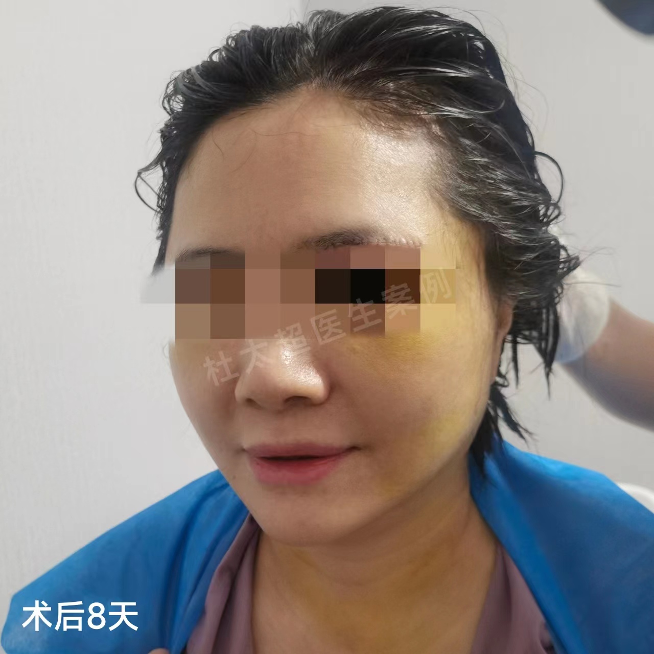 48岁拉皮手术全过程公开,心情堪比过山车! 48岁拉皮手术全过程公开,心情堪比过山车!