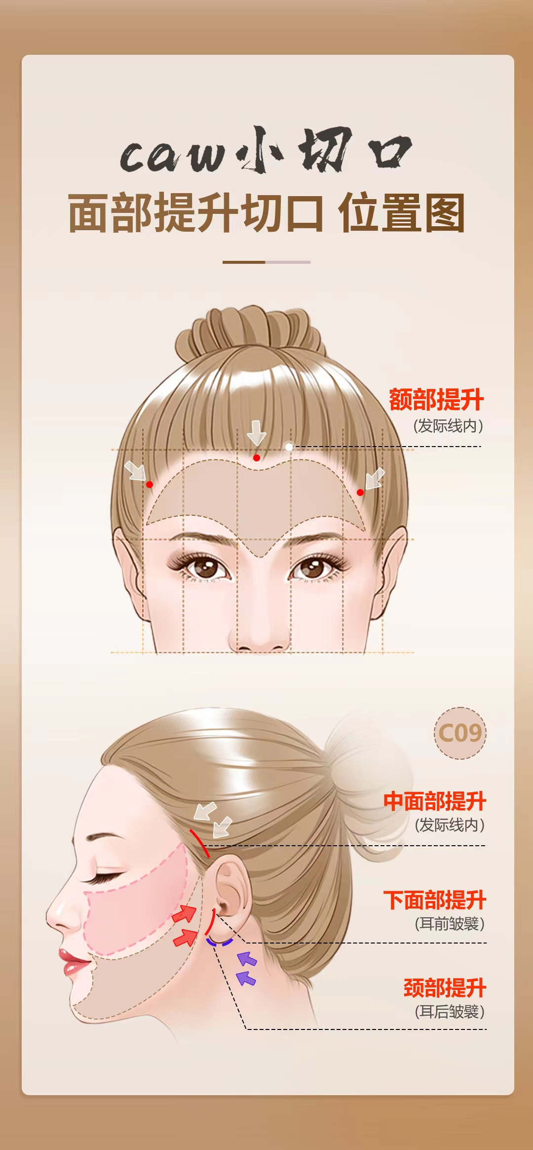 这种类型的法令纹,拉皮手术更有效! 这种类型的法令纹,拉皮手术更有效!