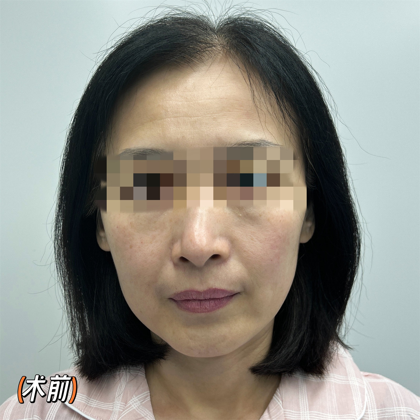 49岁求美者面部松弛下垂,这样做,帮她把问题解决了! 49岁求美者面部松弛下垂,这样做,帮她把问题解决了!