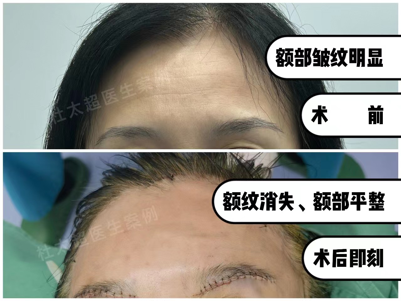 49岁求美者面部松弛下垂,这样做,帮她把问题解决了! 49岁求美者面部松弛下垂,这样做,帮她把问题解决了!
