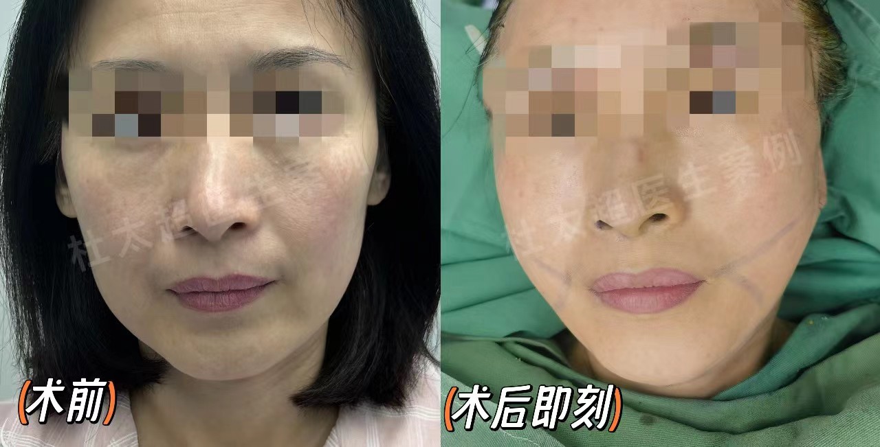 49岁求美者面部松弛下垂，这样做，帮她把问题解决了！