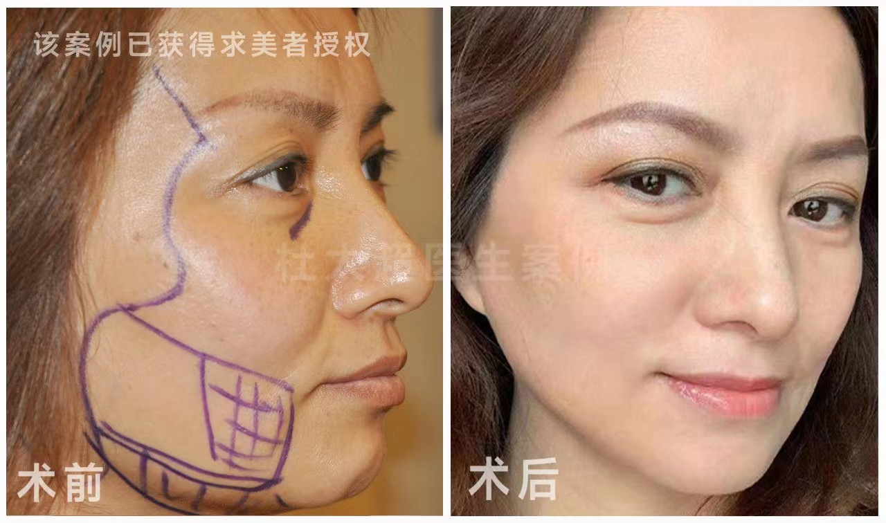 拉皮手术前,了解过这4个问题吗? 拉皮手术前,了解过这4个问题吗?