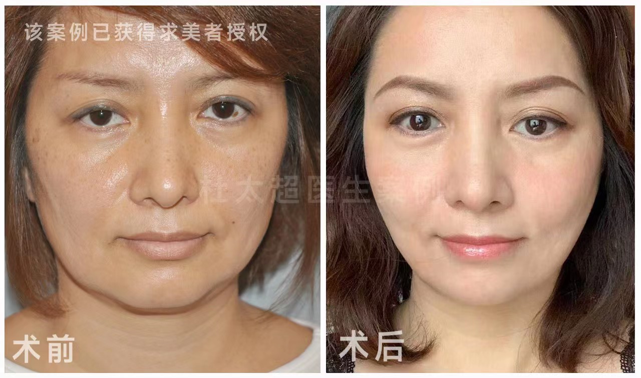 拉皮手术前,了解过这4个问题吗? 拉皮手术前,了解过这4个问题吗?