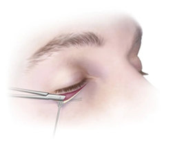 拉皮手术可以去除眼袋? 拉皮手术可以去除眼袋?