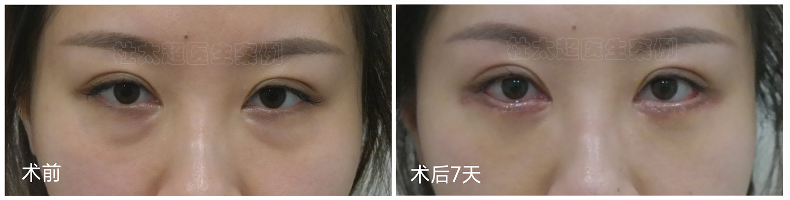 拉皮手术可以去除眼袋? 拉皮手术可以去除眼袋?