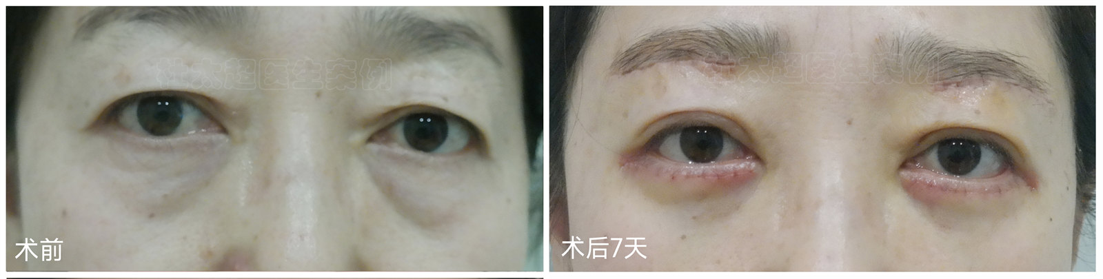 拉皮手术可以去除眼袋? 拉皮手术可以去除眼袋?