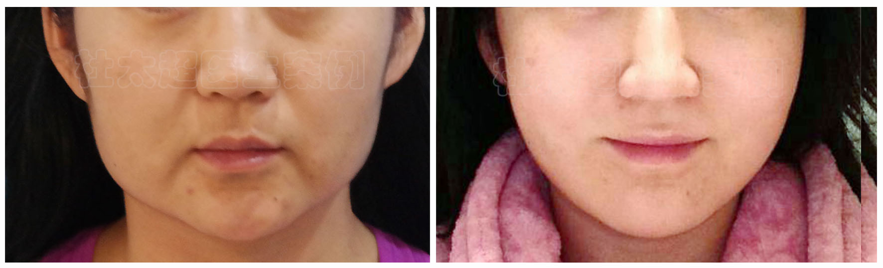 拉皮手术可以去除眼袋? 拉皮手术可以去除眼袋?