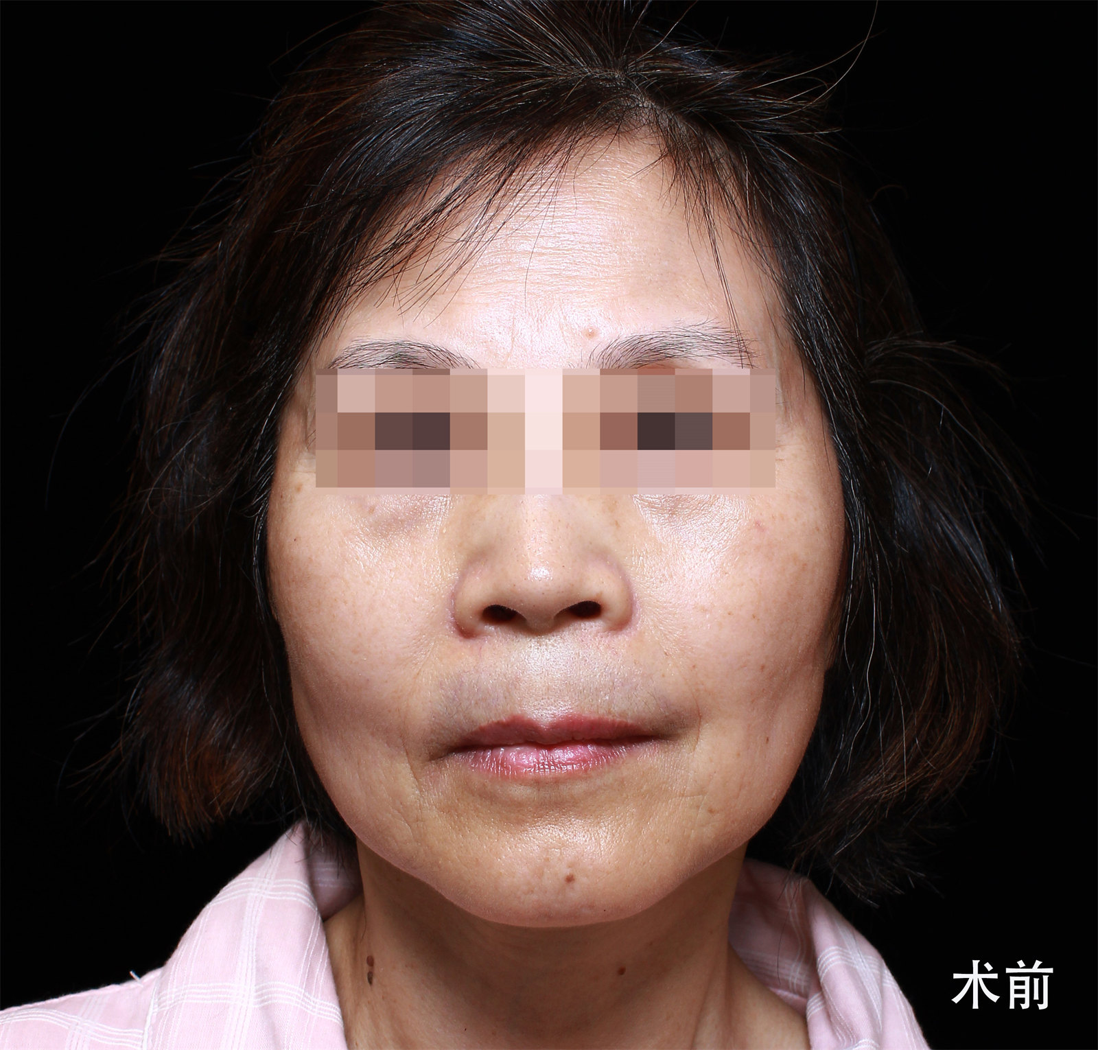 60岁求美者,独自飞北京做拉皮手术,术后7天很惊艳 60岁求美者,独自飞北京做拉皮手术,术后7天很惊艳