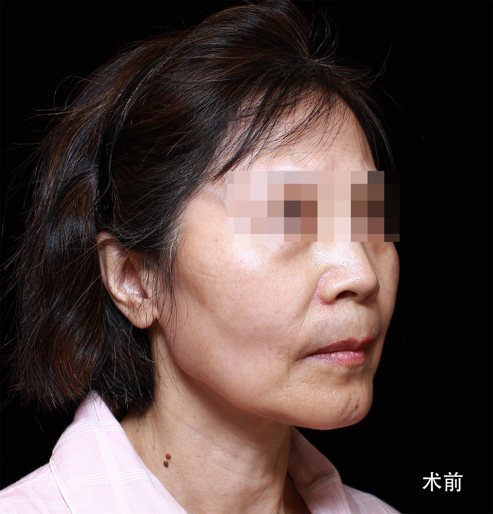 60岁求美者,独自飞北京做拉皮手术,术后7天很惊艳 60岁求美者,独自飞北京做拉皮手术,术后7天很惊艳
