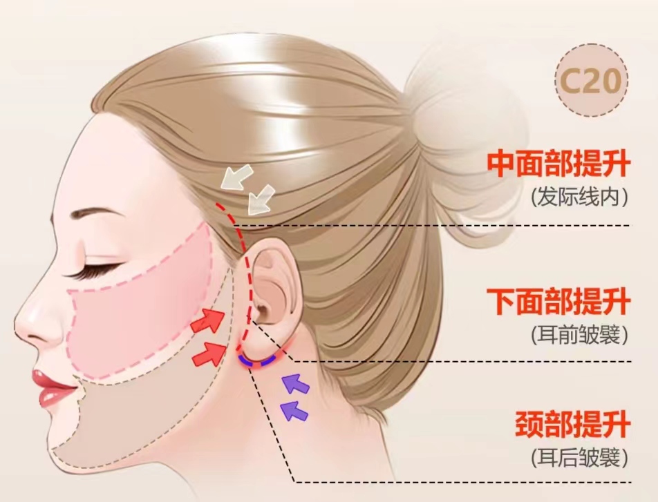 60岁求美者,独自飞北京做拉皮手术,术后7天很惊艳 60岁求美者,独自飞北京做拉皮手术,术后7天很惊艳