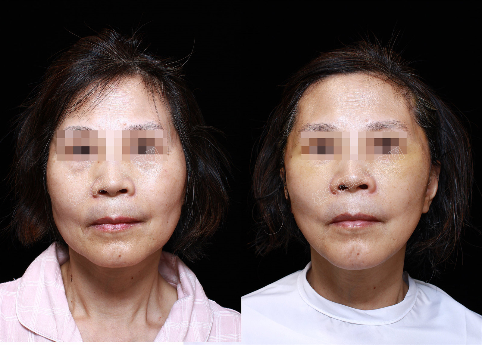 60岁求美者,独自飞北京做拉皮手术,术后7天很惊艳 60岁求美者,独自飞北京做拉皮手术,术后7天很惊艳