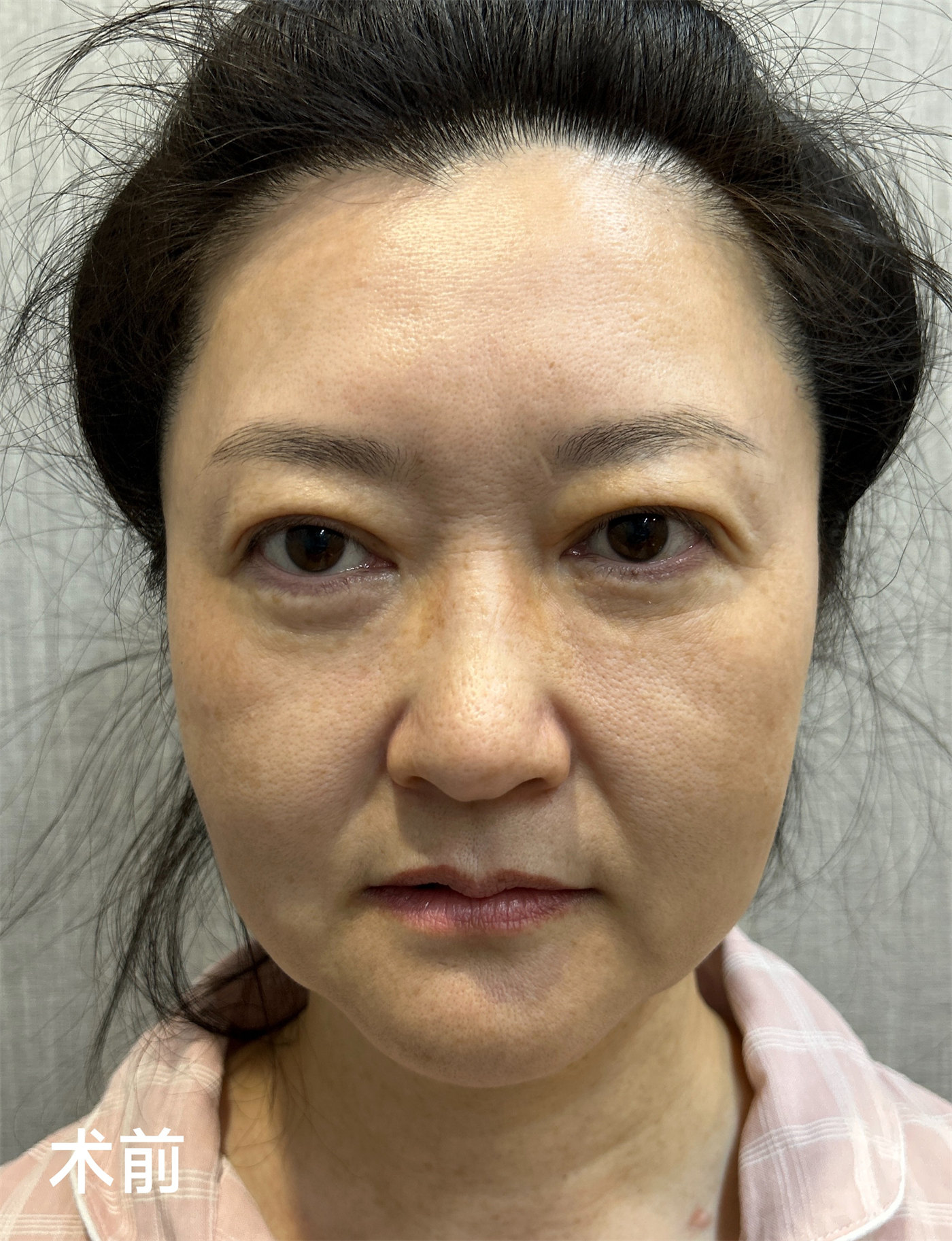 60岁独自从国外回来做拉皮手术,变美原来这么简单! 60岁独自从国外回来做拉皮手术,变美原来这么简单!