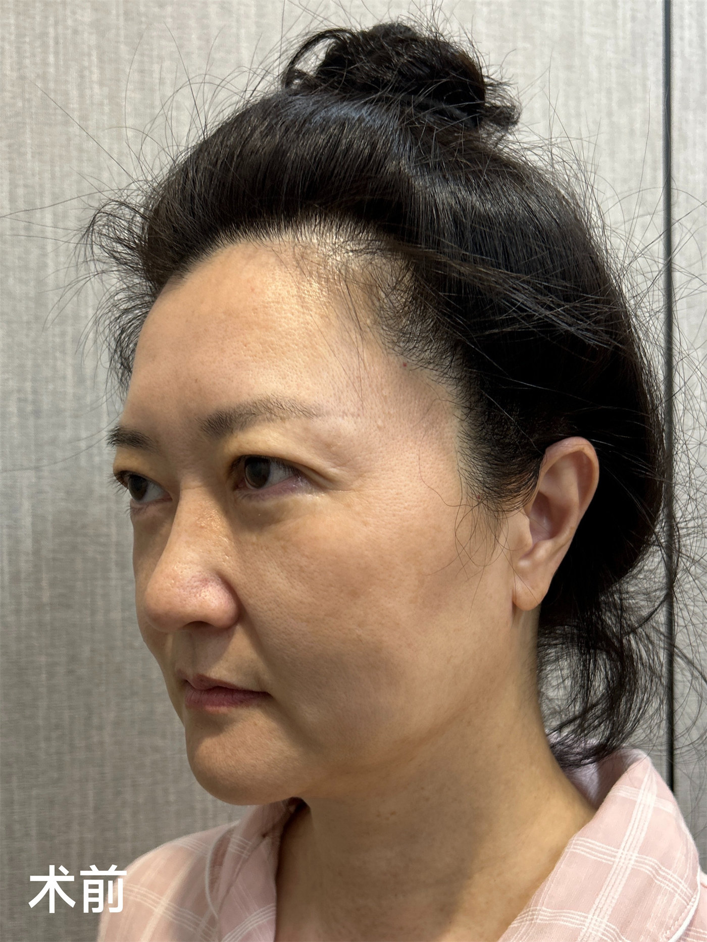 60岁独自从国外回来做拉皮手术,变美原来这么简单! 60岁独自从国外回来做拉皮手术,变美原来这么简单!