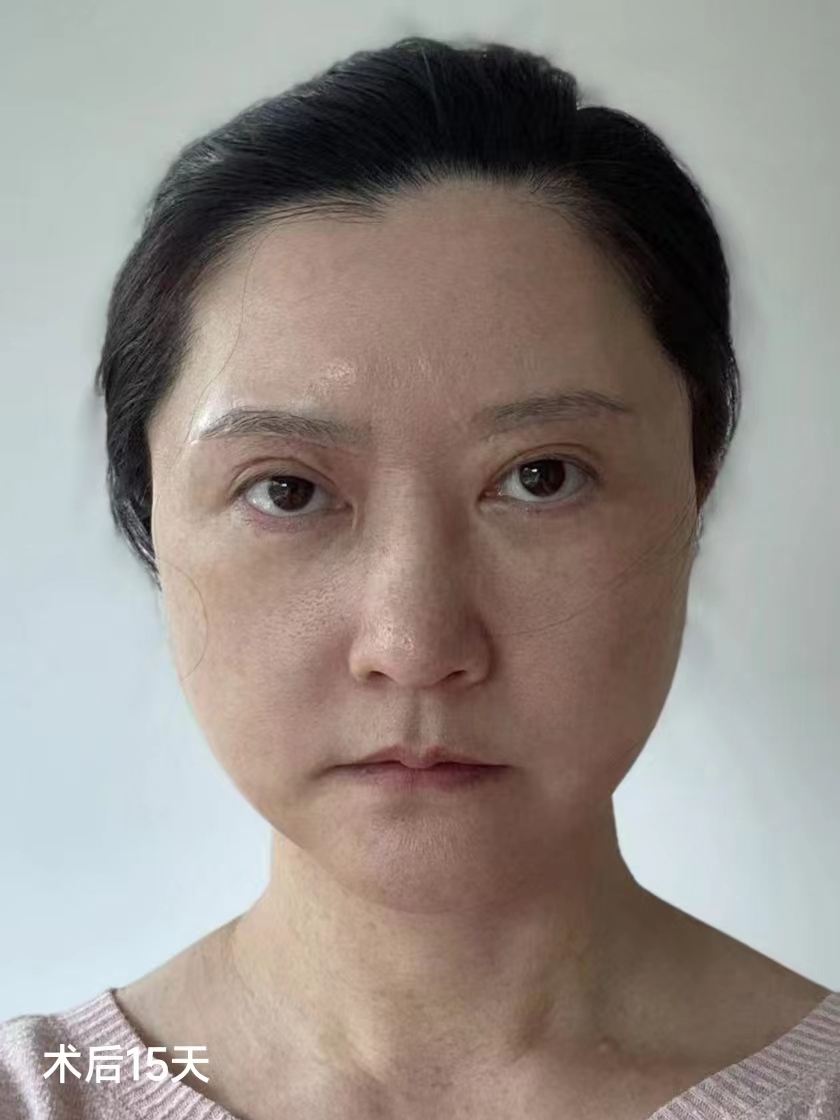 60岁独自从国外回来做拉皮手术,变美原来这么简单! 60岁独自从国外回来做拉皮手术,变美原来这么简单!