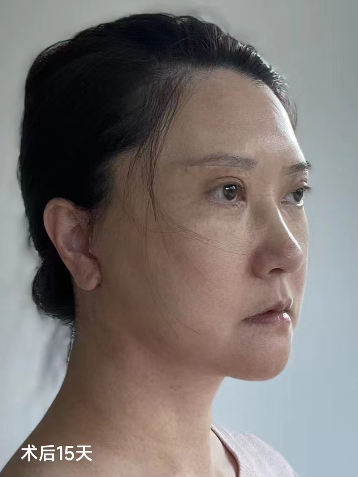 60岁独自从国外回来做拉皮手术,变美原来这么简单! 60岁独自从国外回来做拉皮手术,变美原来这么简单!