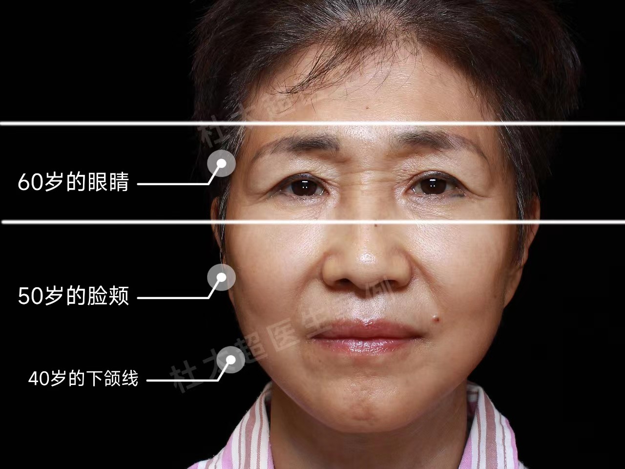 拉皮效果太好了,4个月后又做了去眼袋和眼皮提升,太赞了 拉皮效果太好了,4个月后又做了去眼袋和眼皮提升,太赞了