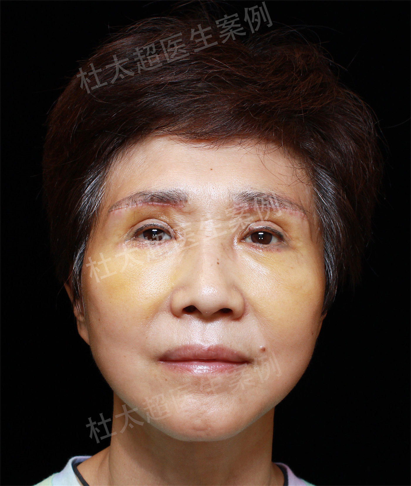 拉皮效果太好了,4个月后又做了去眼袋和眼皮提升,太赞了 拉皮效果太好了,4个月后又做了去眼袋和眼皮提升,太赞了