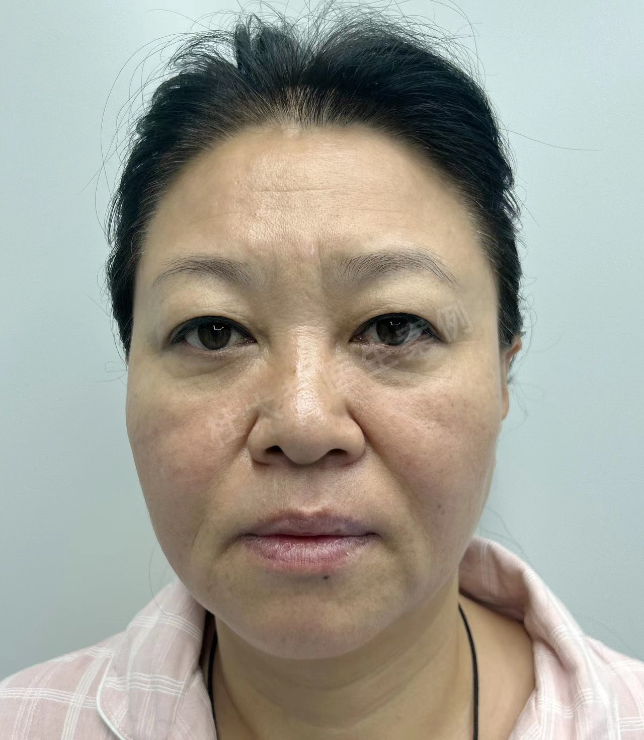 50岁+面部软组织堆积怎么办?拉皮联合方案进行面部年轻化改善 50岁+面部软组织堆积怎么办?拉皮联合方案进行面部年轻化改善