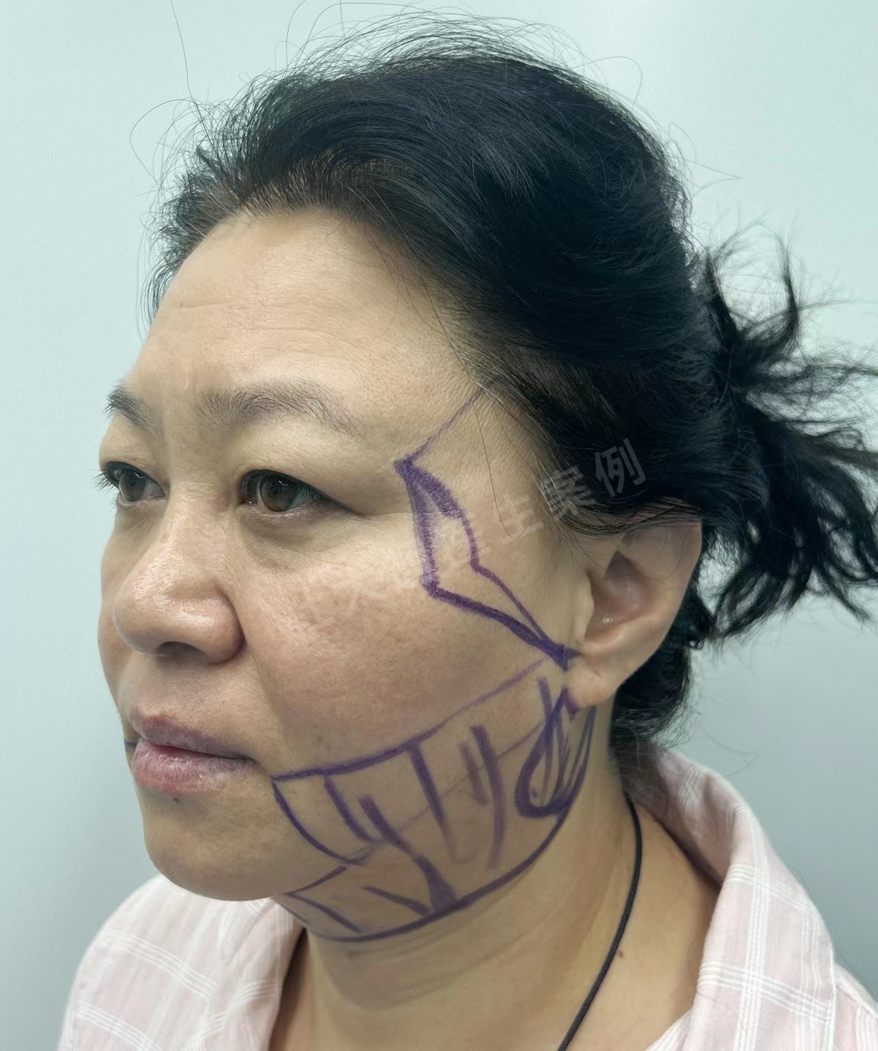 50岁+面部软组织堆积怎么办?拉皮联合方案进行面部年轻化改善 50岁+面部软组织堆积怎么办?拉皮联合方案进行面部年轻化改善