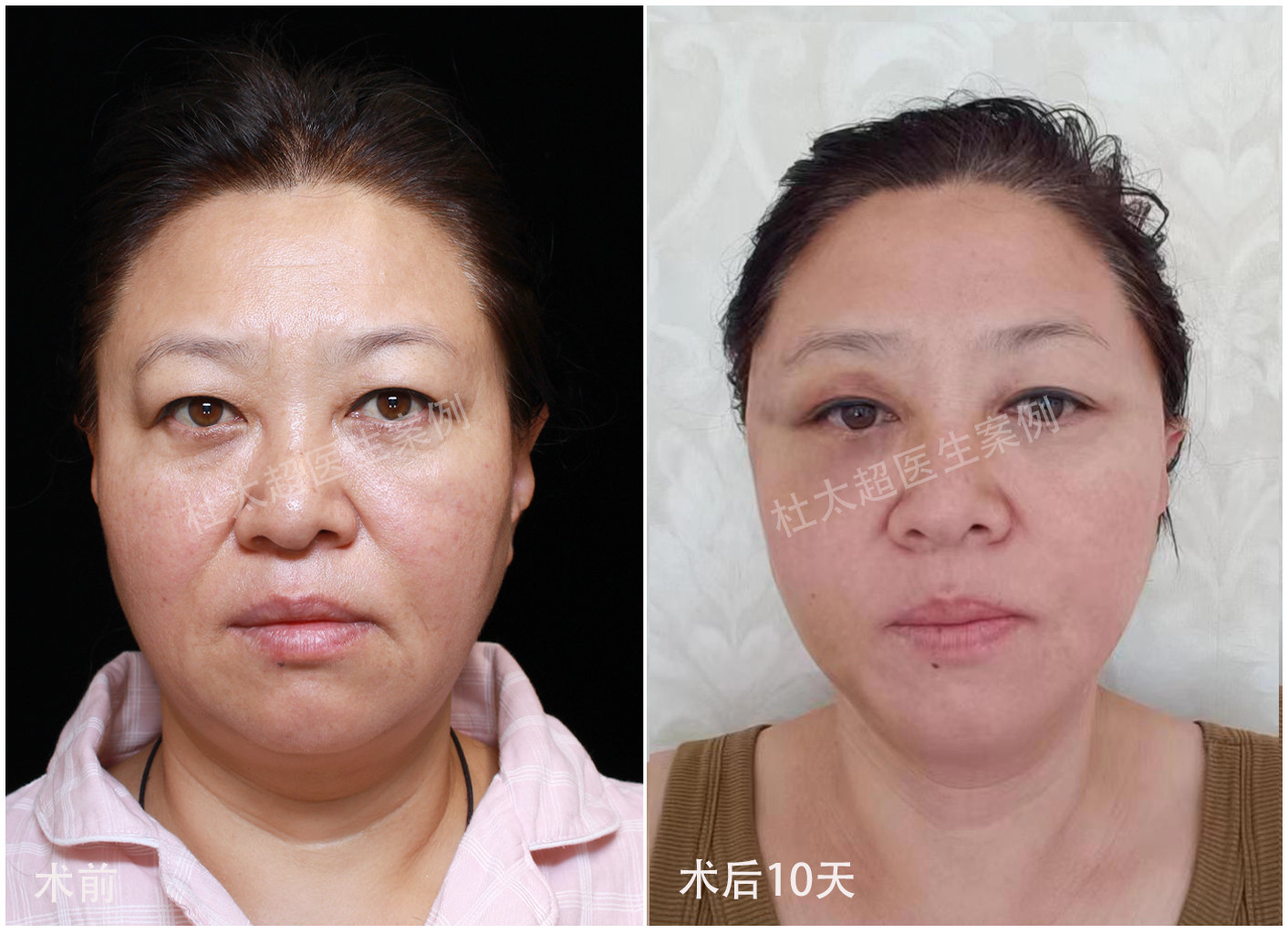 50岁+面部软组织堆积怎么办?拉皮联合方案进行面部年轻化改善 50岁+面部软组织堆积怎么办?拉皮联合方案进行面部年轻化改善