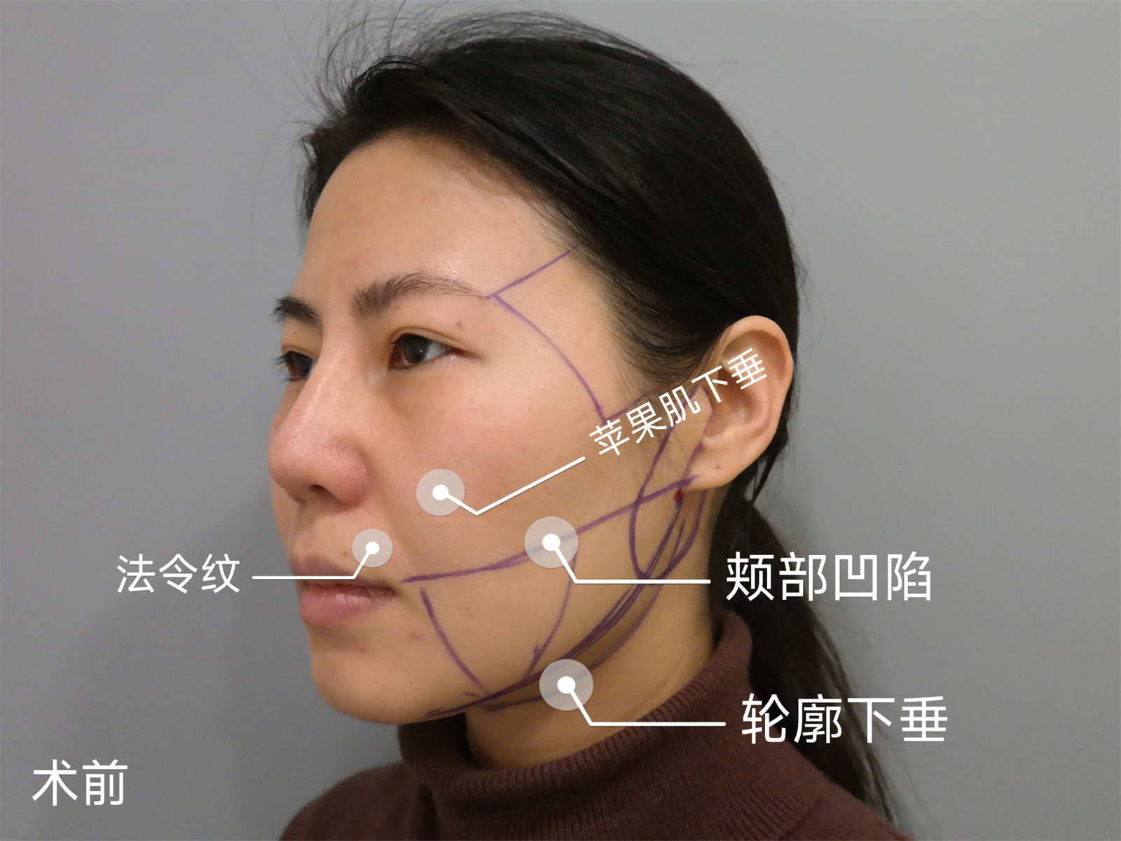 39岁我做了小拉皮+鼻综合,一句话:没后悔! 39岁我做了小拉皮+鼻综合,一句话:没后悔!