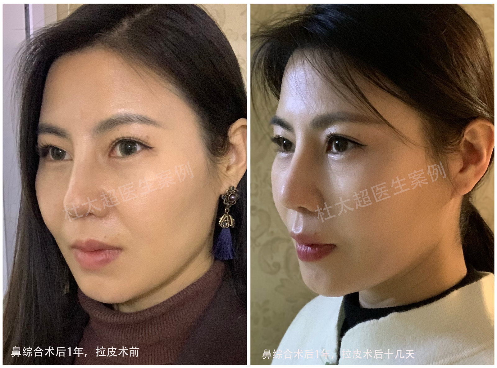 39岁我做了小拉皮+鼻综合,一句话:没后悔! 39岁我做了小拉皮+鼻综合,一句话:没后悔!