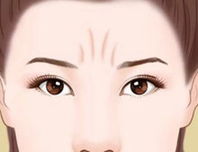 川字纹如何消除? 川字纹如何消除?