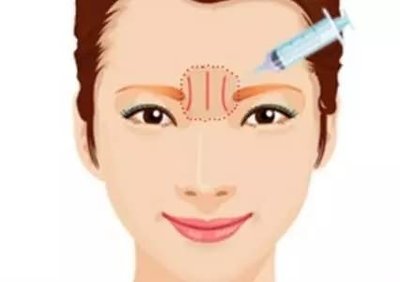 川字纹如何消除? 川字纹如何消除?