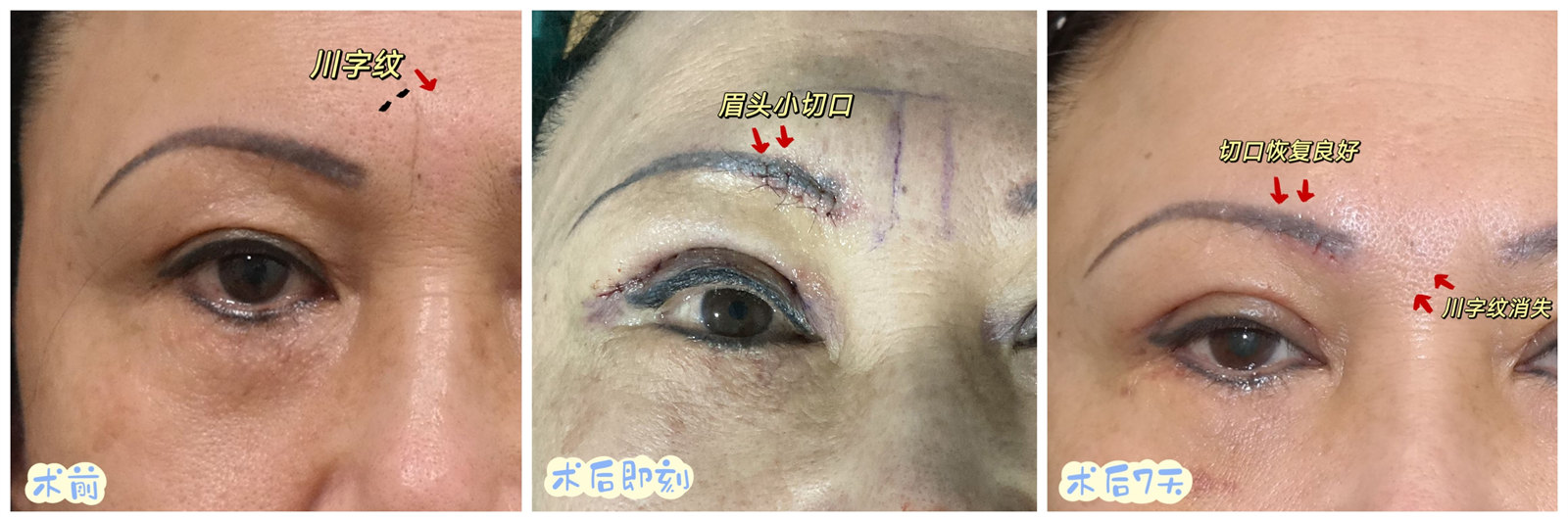 川字纹如何消除? 川字纹如何消除?