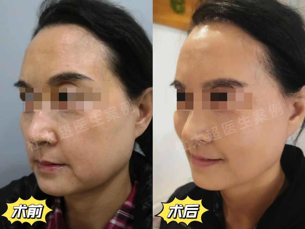 做完拉皮手术年轻10岁，分享3个值得做的理由！