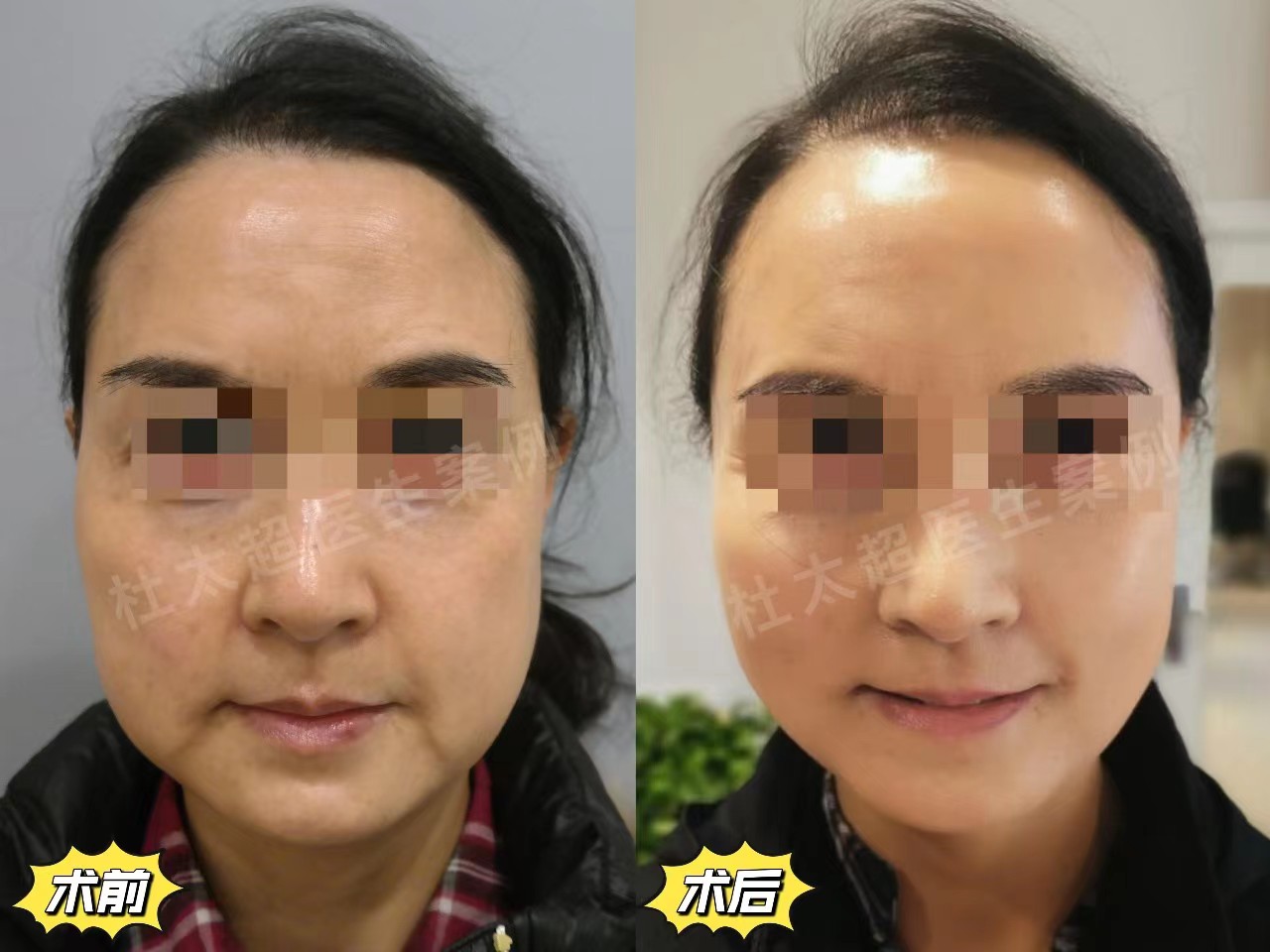 做完拉皮手术年轻10岁，分享3个值得做的理由！