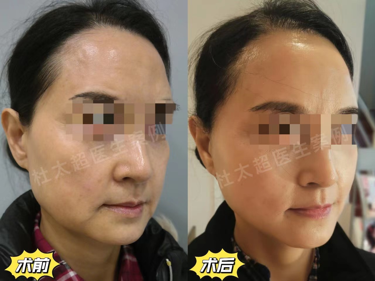 做完拉皮手术年轻10岁，分享3个值得做的理由！