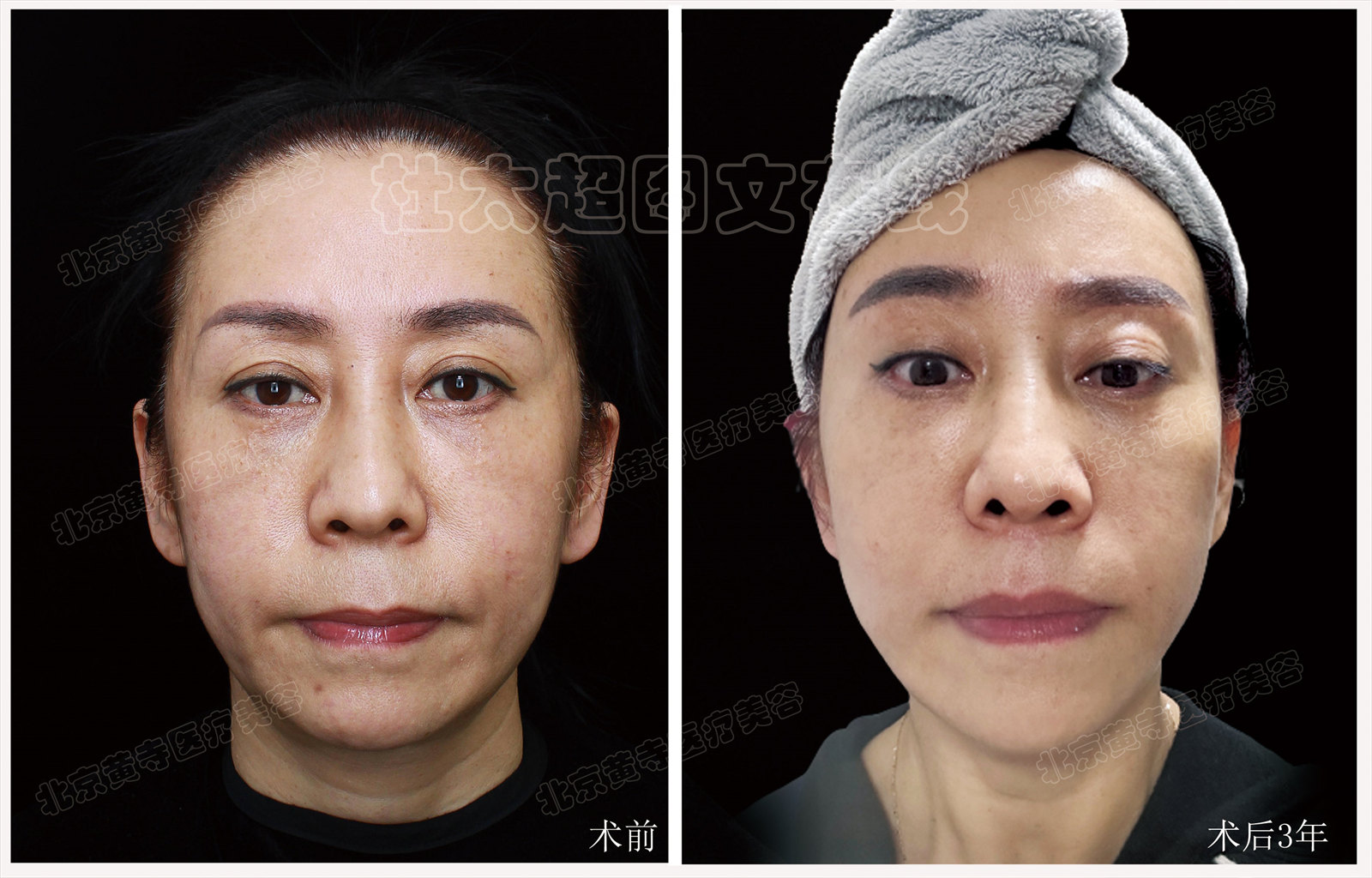 拉皮面部提升术后近期随访10天