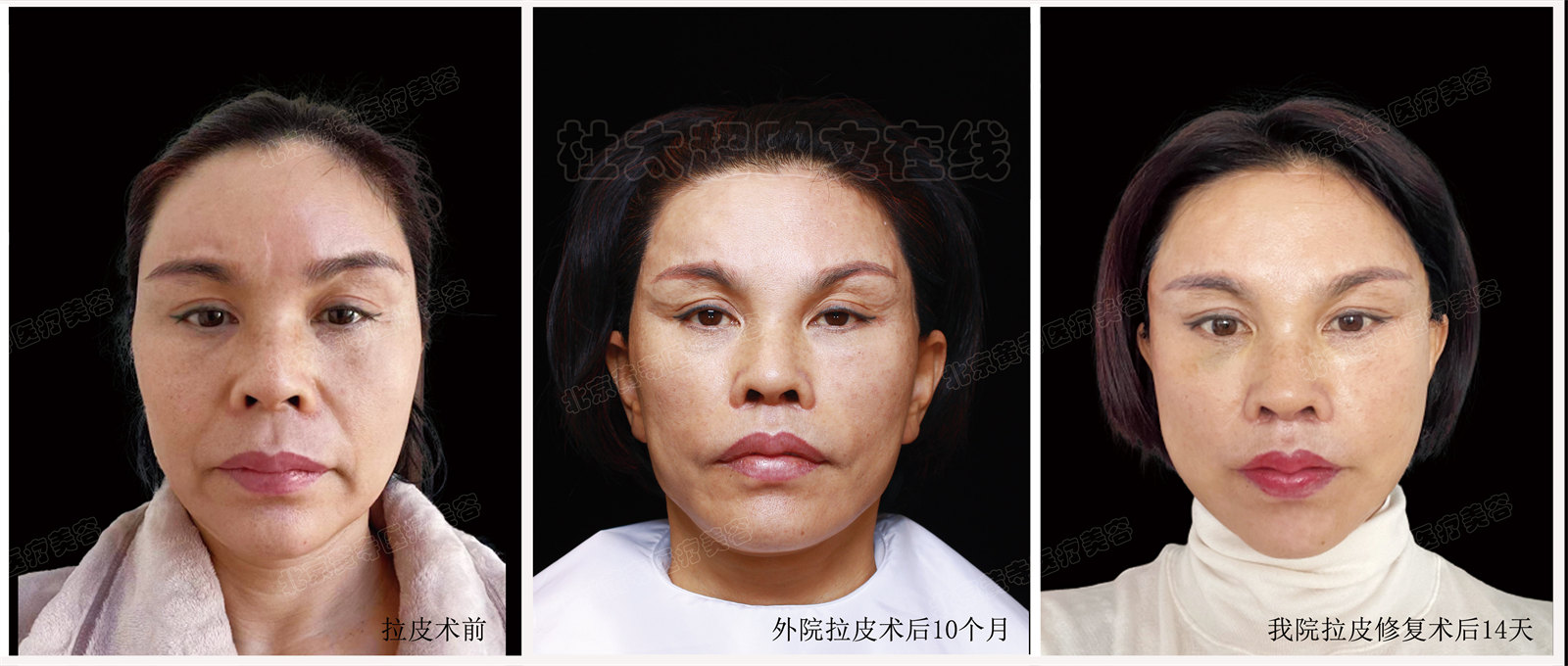 拉皮面部提升术后近期随访10天