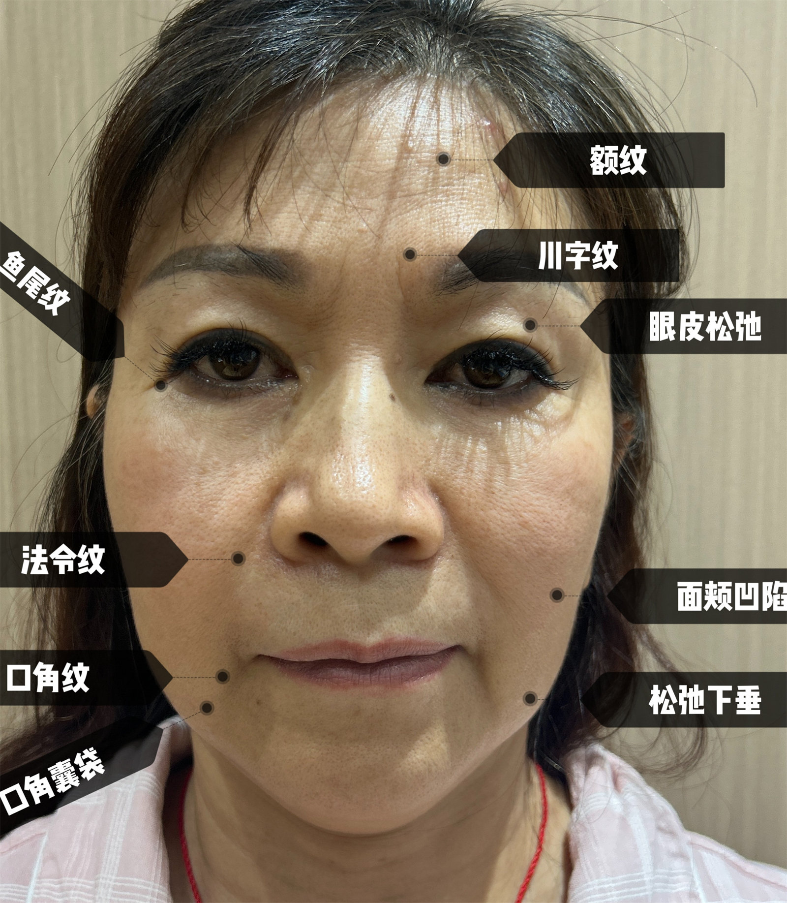 58岁，1次北京之行，7天恢复期，术后18天变这样！