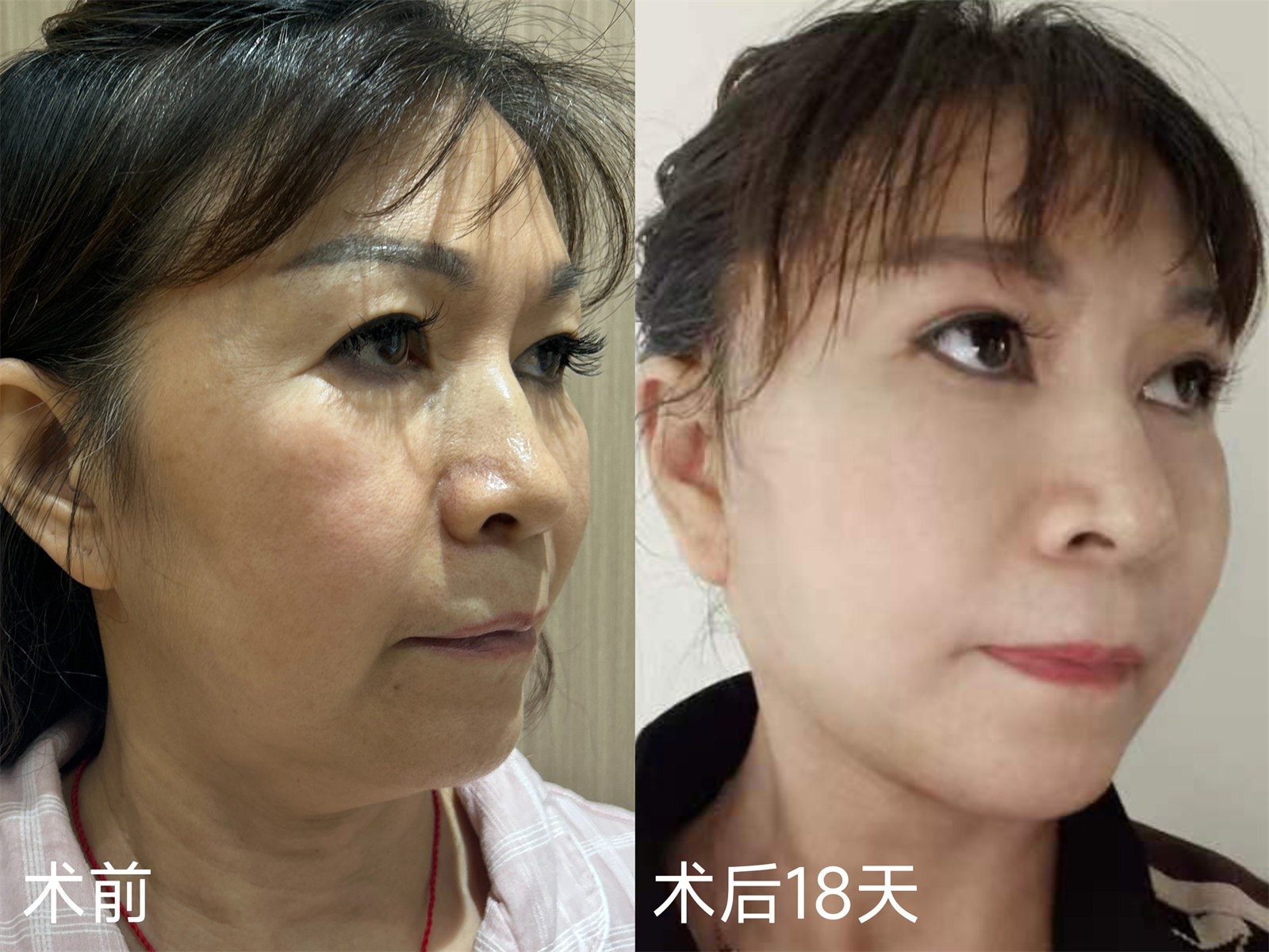 58岁，1次北京之行，7天恢复期，术后18天变这样！