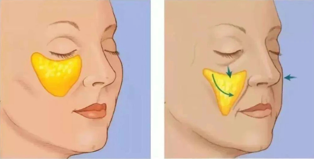 苹果肌下移1公分人老10岁，这样做，让苹果肌复位恢复年轻态