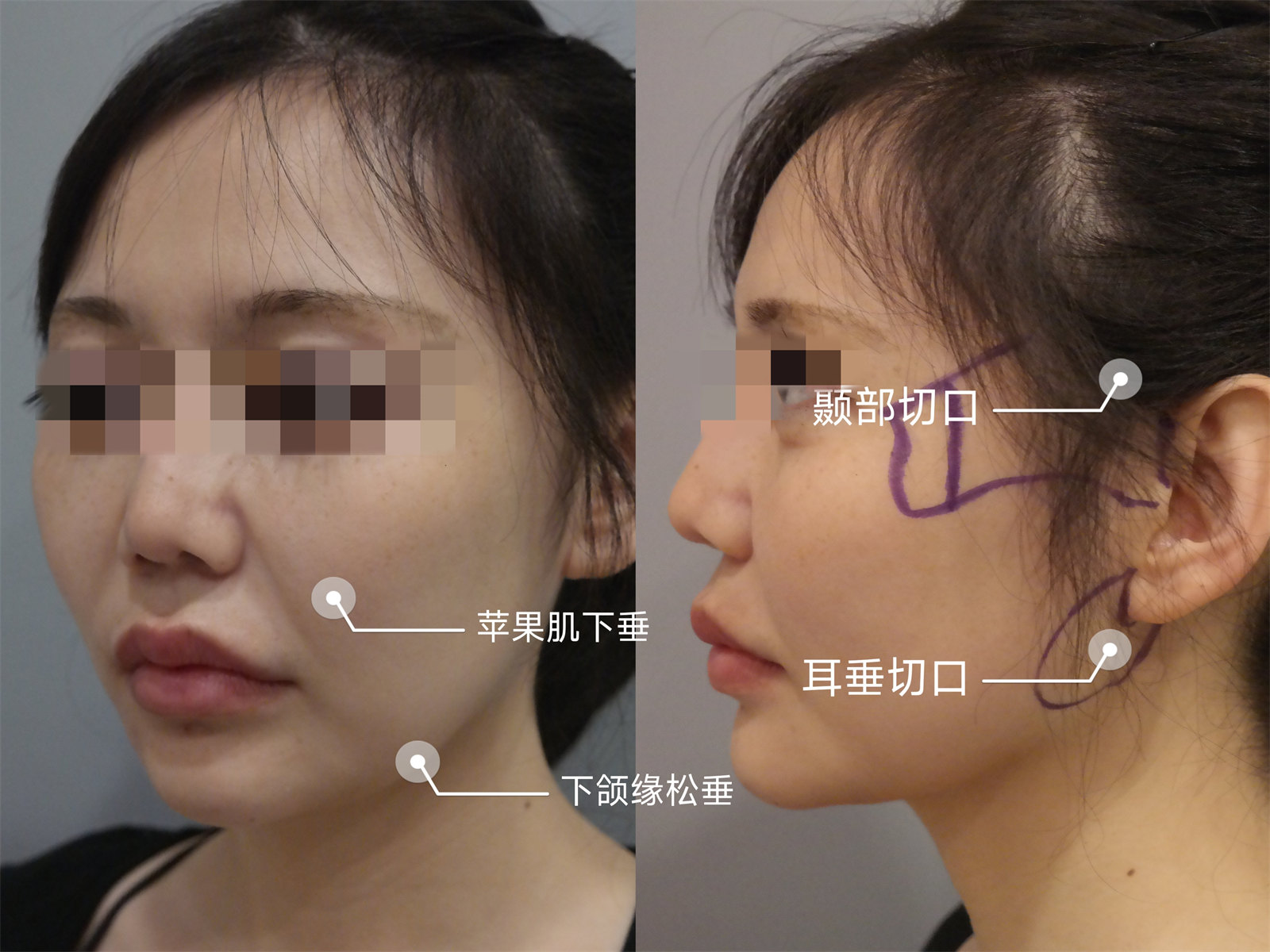 苹果肌下移1公分人老10岁，这样做，让苹果肌复位恢复年轻态