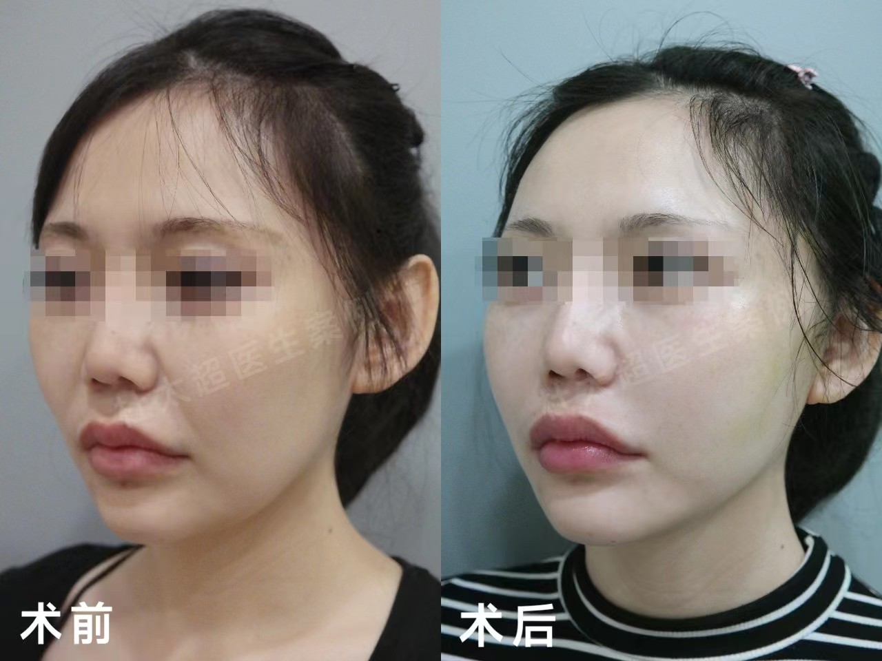 苹果肌下移1公分人老10岁，这样做，让苹果肌复位恢复年轻态