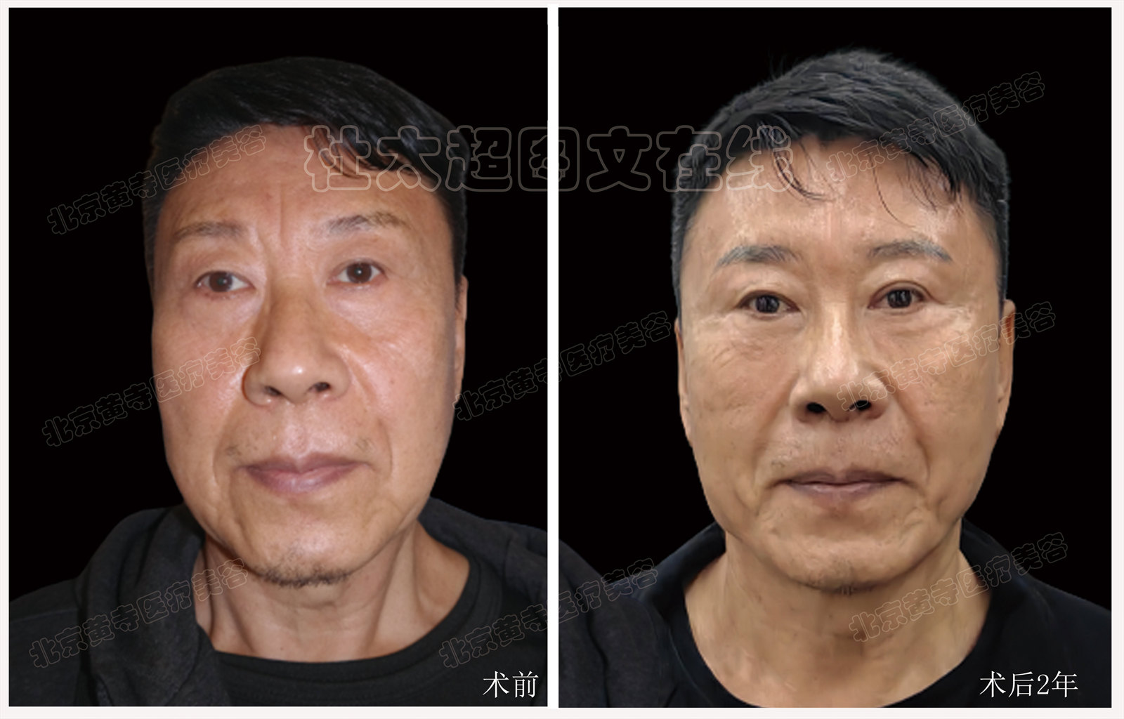 眼皮+眼袋+川字纹术后2年随访