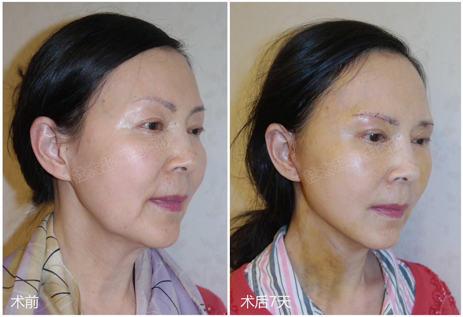 拉皮手术后遗症多吗？到底要不要做？