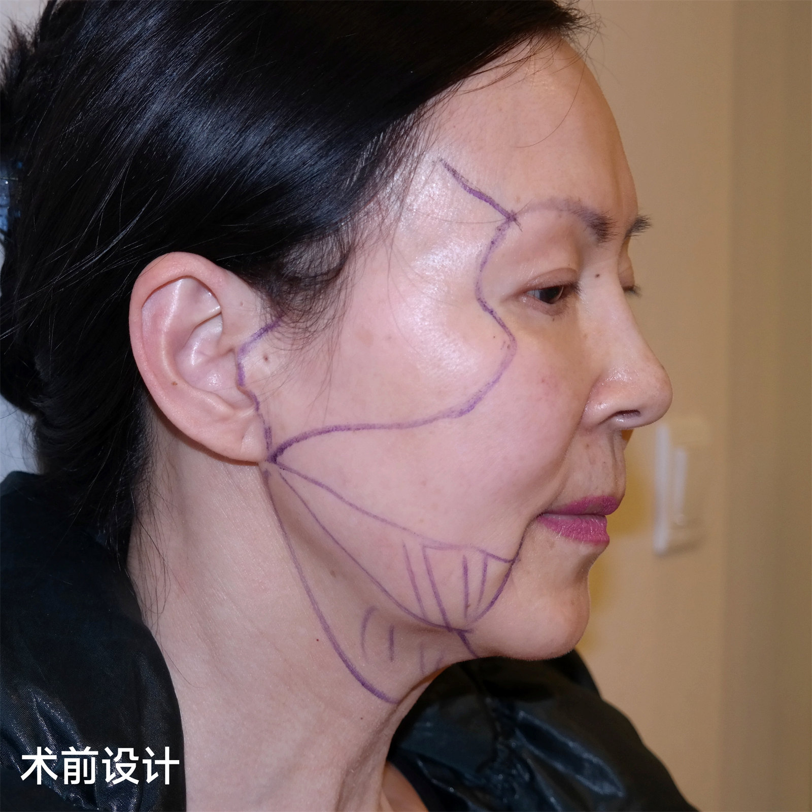 拉皮手术后遗症多吗？到底要不要做？