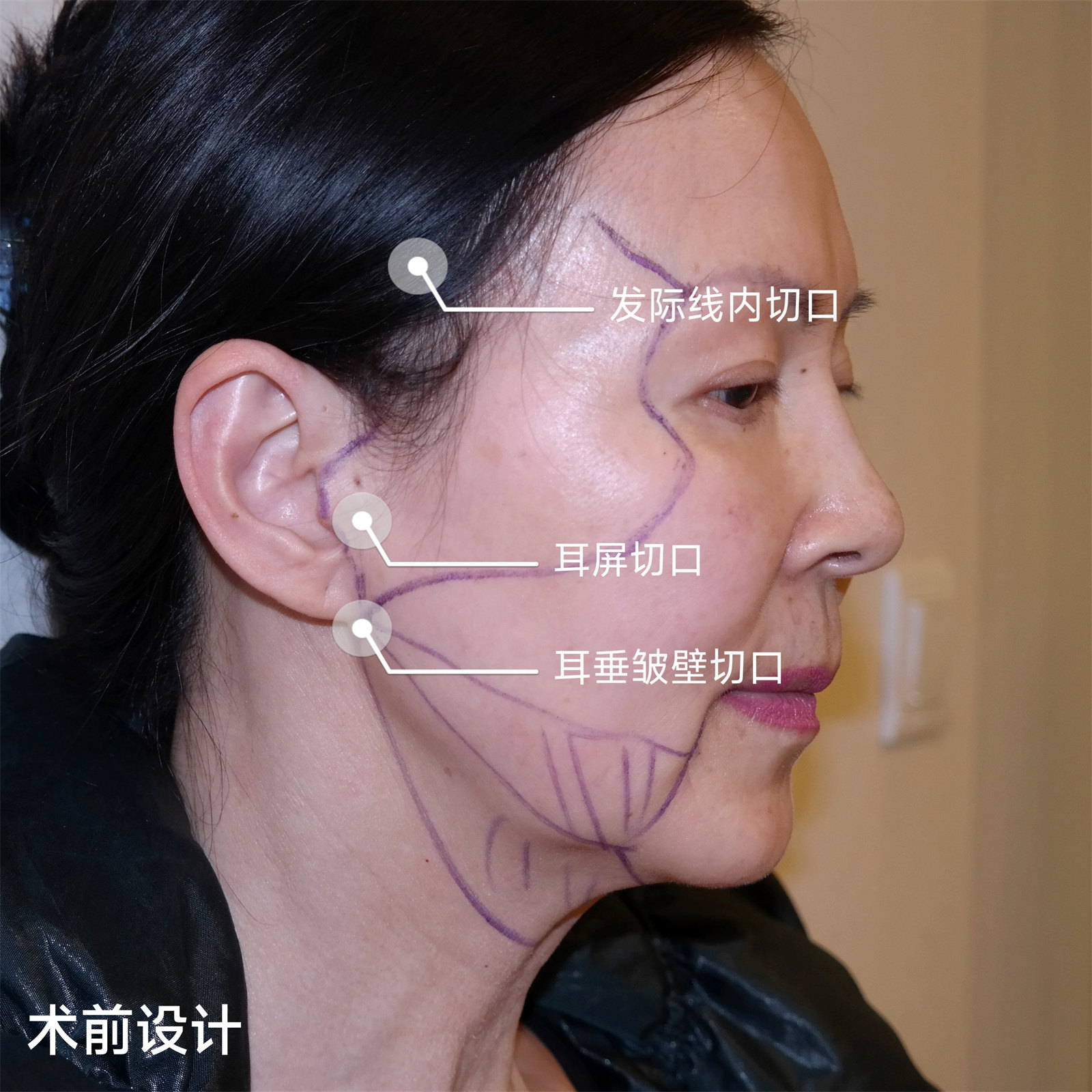 拉皮手术后遗症多吗？到底要不要做？